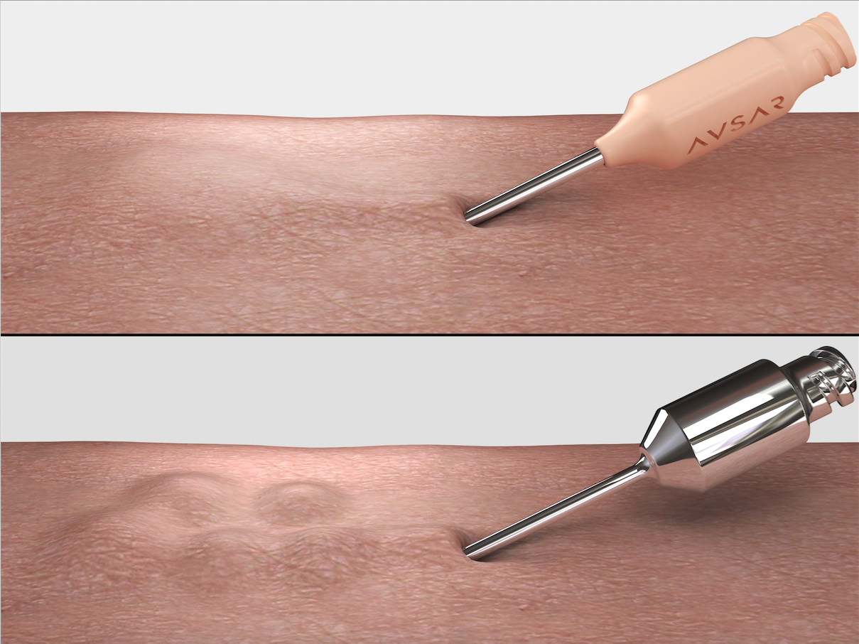 comparison cannula